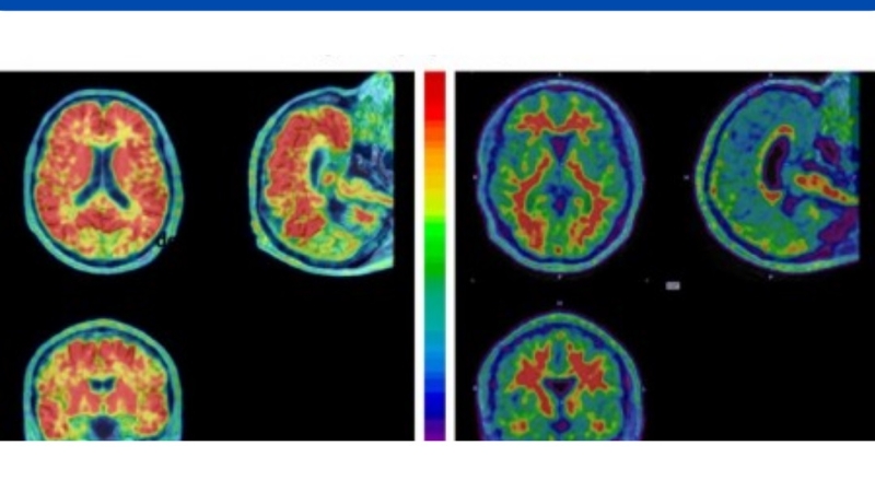 Técnica realizada por equipamento da Rede PREMiUM permite investigar Alzheimer em pessoas com síndrome de Down